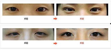 双眼皮手术的过程视频,从术前准备到术后恢复