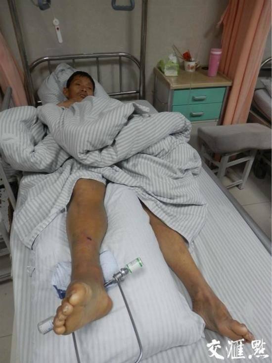 腿断视频,腿部骨折瞬间，惊心动魄的急救瞬间