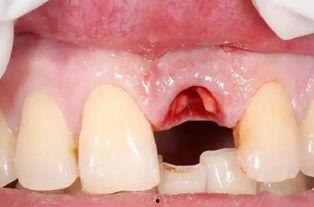 拔烂牙根视频全过程,疼痛与勇气并存